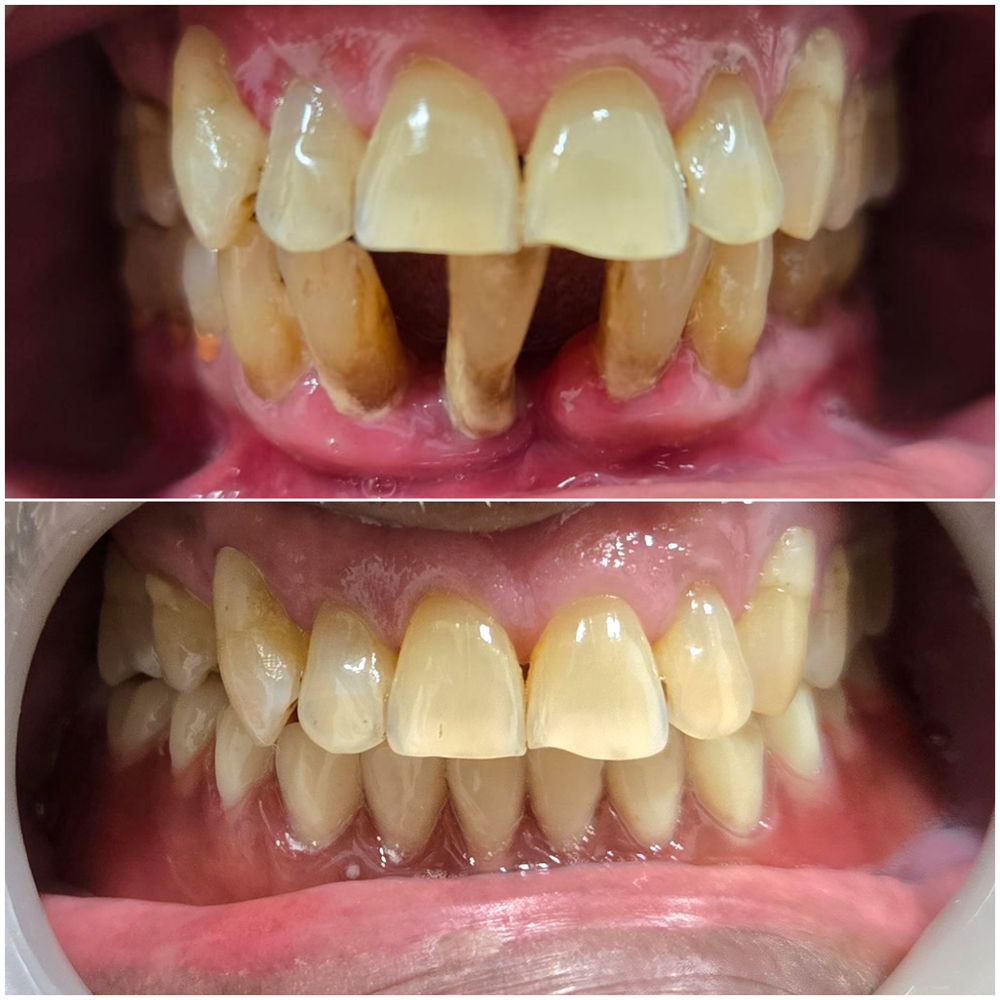 All-on-4 implant smile restoration result