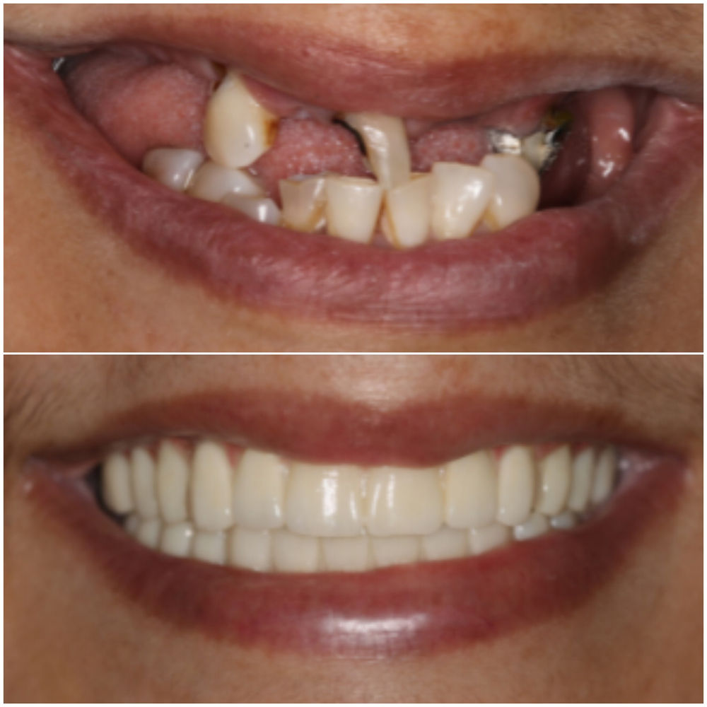 Full-arch implant rehabilitation patient smile