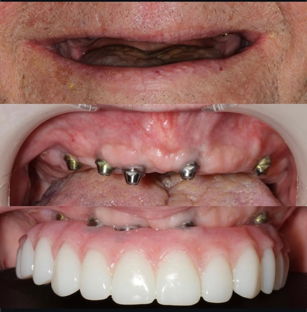 Dental implant smile makeover outcome